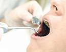 歯内療法