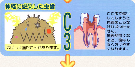 C3 ここまで進行してしまうと神経をとらなければいけません。神経が無くなると、歯はもろく欠けやすくなります。